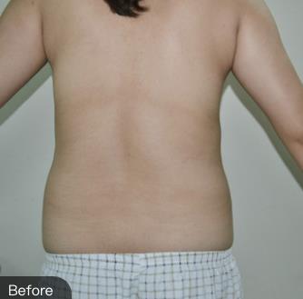 包头华美徐三明腰腹部吸脂一年后，康康我的腰围细了多少!