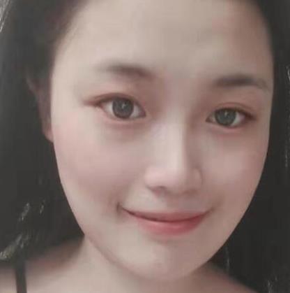 北京八大处靳小雷下颌角磨骨案例分享：从20岁开始变美了！