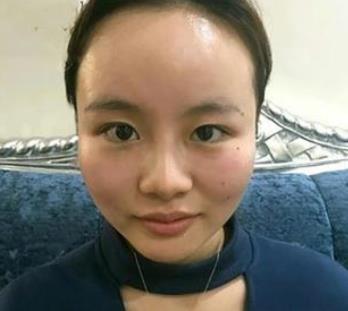 安徽省立医院整形外科割双眼皮感受分享，附上