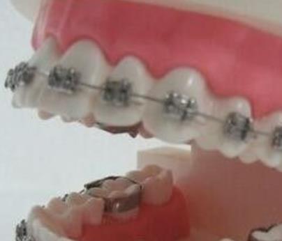 第四军医大学口腔医院牙齿矫正案例分享，放心微笑不惧尴尬