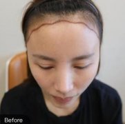 广州新生植发怎么样？看发际线改良手术对比案例