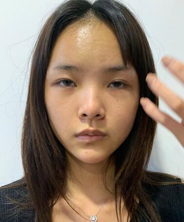 郑州惠美整形医院面部脂肪填充一览：让我重拾少女脸