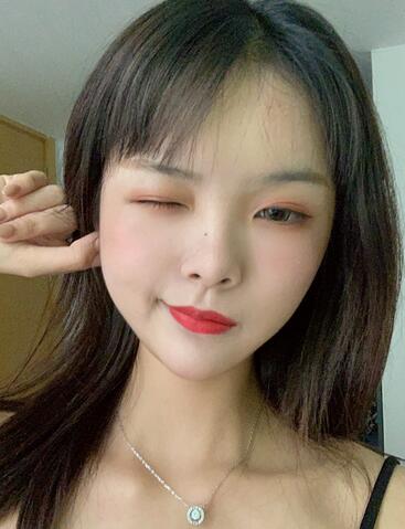 郑州惠美整形医院面部脂肪填充一览：让我重拾少女脸