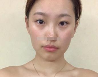 北京同仁医院整形美容科瘦脸介绍恢复果怎么样