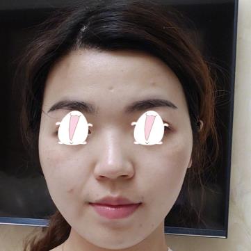 北京医院激光美容外科祛斑果如何？附前后