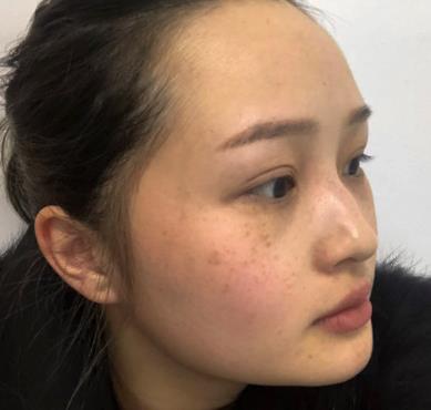 北京中关村医院激光美容科祛斑介绍展示，前后果变化欣赏