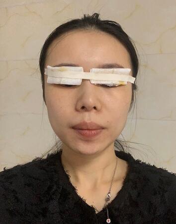 珠海九龙医院整形医院双眼皮果前后明X，术后恢复过程分享