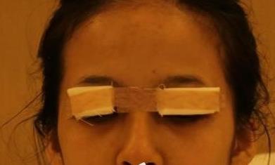 浙江省人民医院整形外科做外切祛眼袋3个月恢复