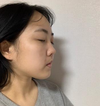 浙医二院整形科隆鼻怎么样？术后介绍果