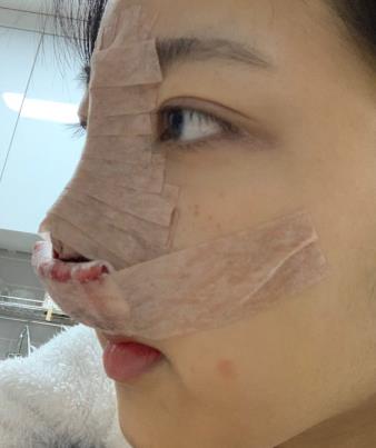 浙医二院整形科隆鼻怎么样？术后介绍果