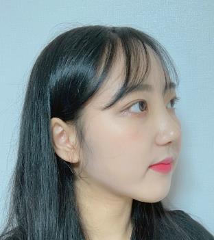 浙医二院整形科隆鼻怎么样？术后介绍果