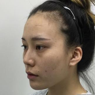 北京玉之光王明利医生面部脂肪填充介绍反馈！