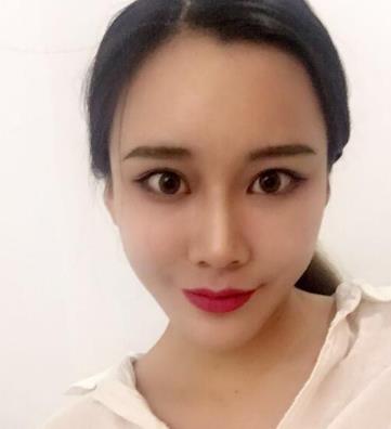 北京玉之光王明利医生面部脂肪填充介绍反馈！
