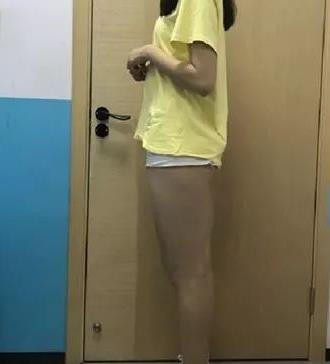 山东省立医院整形科高峰大腿吸脂如何？介绍分享