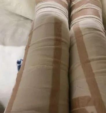 山东省立医院整形科高峰大腿吸脂如何？介绍分享