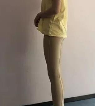 山东省立医院整形科高峰大腿吸脂如何？介绍分享