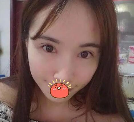 中南大学湘雅二医院整形科双眼皮介绍