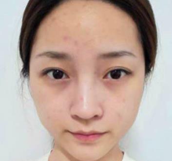 上海九院李青峰做鼻子如何？案例手术风格尽显！