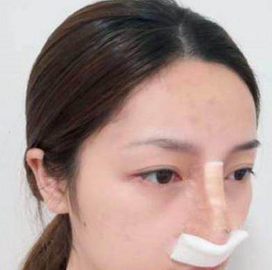 上海九院李青峰做鼻子如何？介绍手术风格尽显！
