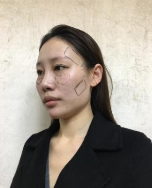 哈尔滨欧华整形医院玻尿酸丰太阳穴恢复介绍欣赏
