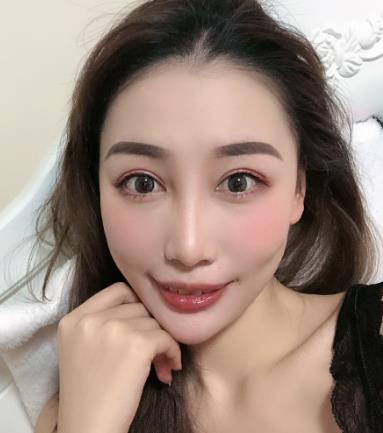 哈尔滨欧华整形医院玻尿酸丰太阳穴恢复介绍欣赏