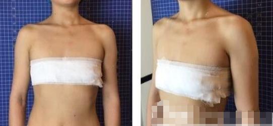 浙江省立同德医院整形外科做曼托假体隆胸恢复变化图~实拍果