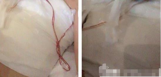 浙江省立同德医院整形外科做曼托假体隆胸恢复变化图~实拍果