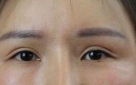杭州整形医院整形美容科孙豪双眼皮修复术后8个月果图~恢复得很不错