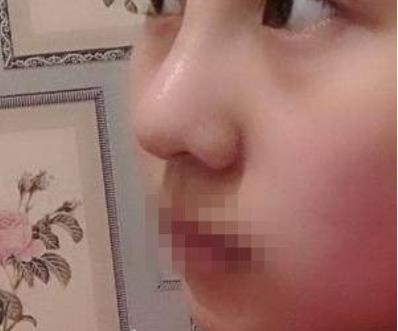 浙江省人民医院整形外科做鼻子已经三个多月了，果恢复得很稳定