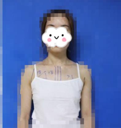 衢州市中医医院整形美容科隆胸要多少钱?新版价格表和果照片分享
