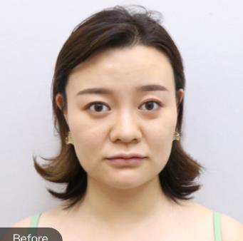 海南面部埋线提升面诊哪家医院好?省人民医院整形科介绍分析果