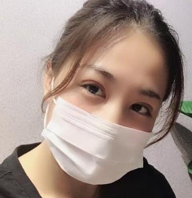 北京协和医院整形科赵茹双眼皮手术案例：大眼你值得拥有！
