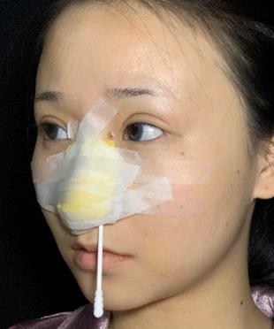 北京八大处鼻部手术贵吗？专家案例先参考再决定！