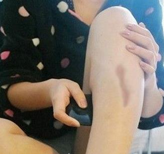 河北医科大学医院美容整形科去疤痕介绍口碑