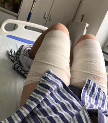 上海九院整形科做的全身吸脂手术，术后真的瘦了一大圈