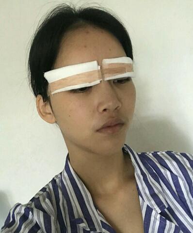 长沙卓而美怎么样?做双眼皮术后一个月的恢复果照