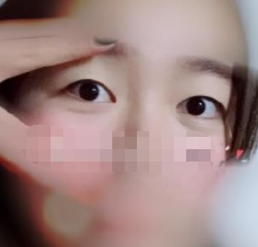 郑州大学附属郑州中心医院医疗美容割双眼皮介绍，直观感受术后果