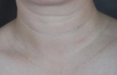 长沙美之峰李健医生打嗨体去颈纹术后1个月恢复果照，对比明X