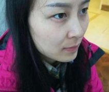 北京八大处杨明勇做双眼皮案例！说说做眼睛整形的心理感受！