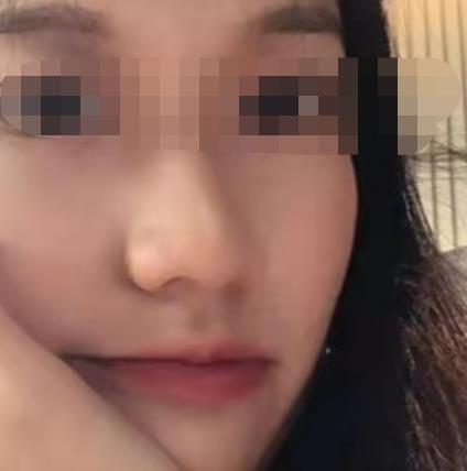 长沙浏阳市人民医院美容科激光祛斑怎么样？手术价格参考