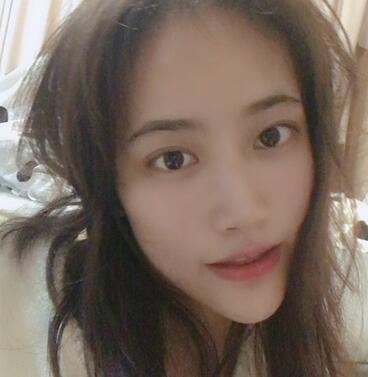 宜宾市第一人民医院整形美容外科隆鼻介绍展示，恢复记录给你看