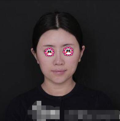 郑大一附院整形外科隆鼻咋样?介绍果和价格费用一览