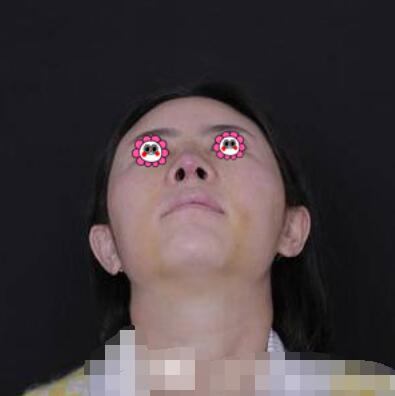 郑大一附院整形外科隆鼻咋样?介绍果和价格费用一览
