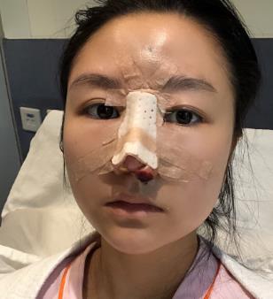 上海九院专家做的隆鼻手术，果一定没有让你失望！