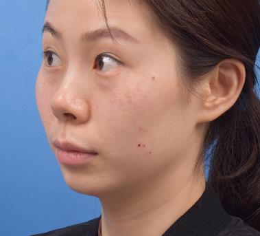宜昌市人民医院美容科去疤痕多少钱？手术果一览