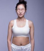 北京协和医院整形腰腹吸脂案例，术后果差别明X！