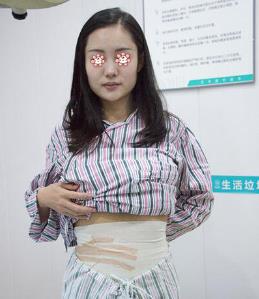 北京协和医院整形腰腹吸脂介绍，术后果差别明X！
