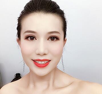 广州中科美整形医院费用和双眼皮分享~