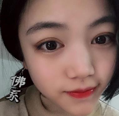 北京八大处靳小雷医生双眼皮果如何？介绍背后是无尽的自信！