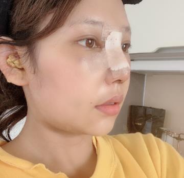 上海华美双眼皮和隆鼻同时做，一起来看看术后果吧！